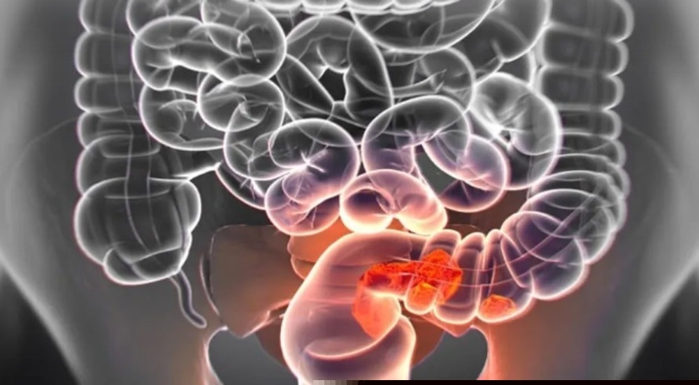 Harvard revela alimento que protege contra o câncer de intestino