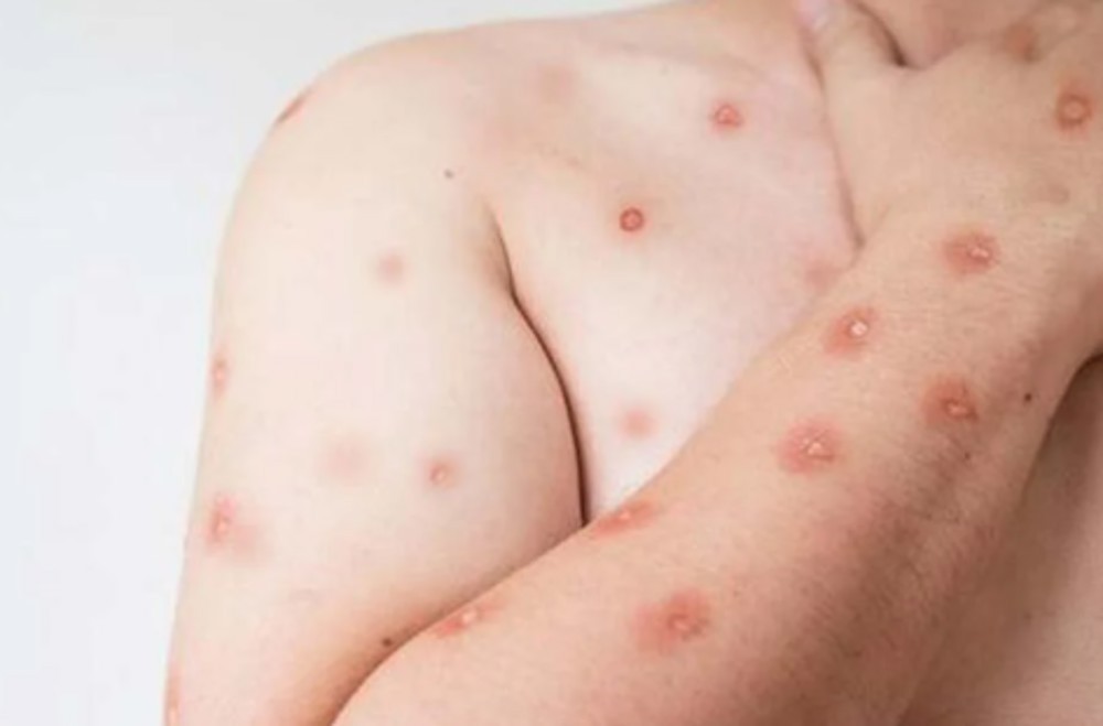 Região Norte do Brasil registra casos de mpox
