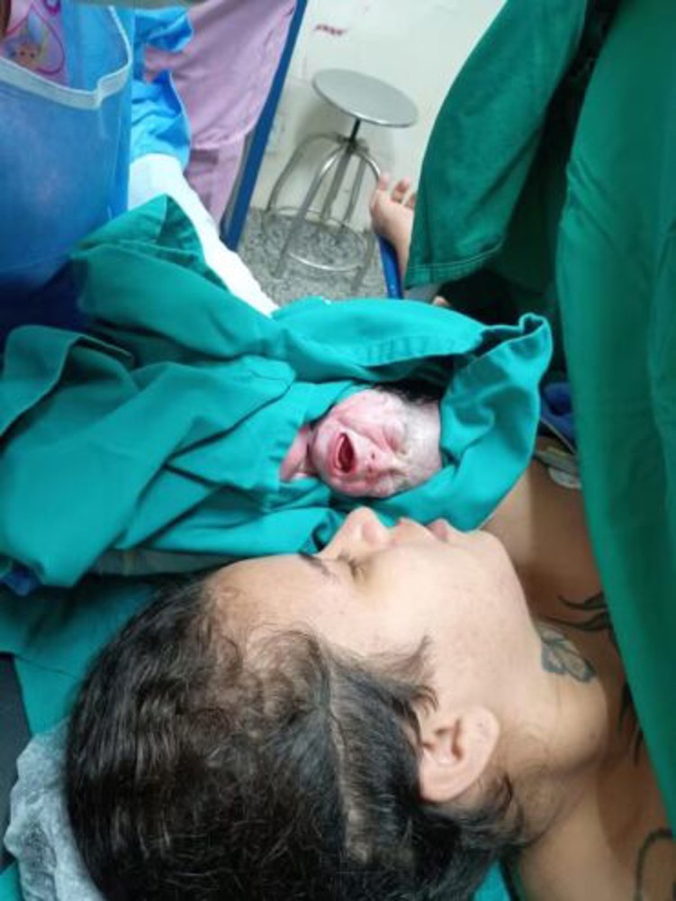 Parto raro de trigêmeas univitelinas é realizado na nova maternidade do Hospital de Base