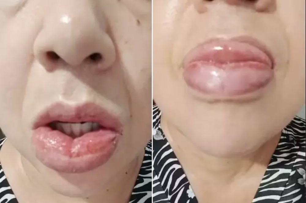 Mais de 1,2 mil pessoas relataram reação a pasta da Colgate