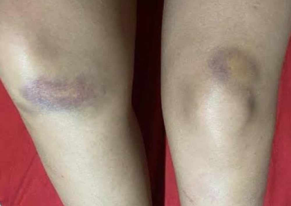 Após terminar relacionamento, mulher é atacada a pauladas e socorrida à UPA