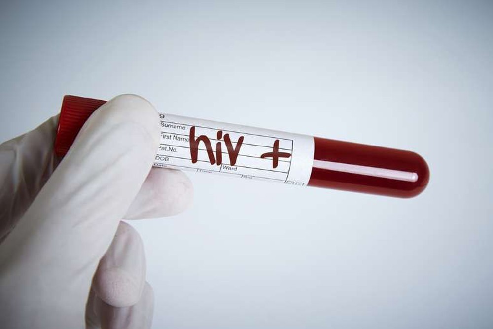 Pacientes com diagnóstico tardio de HIV têm 6 vezes mais chances de morrer