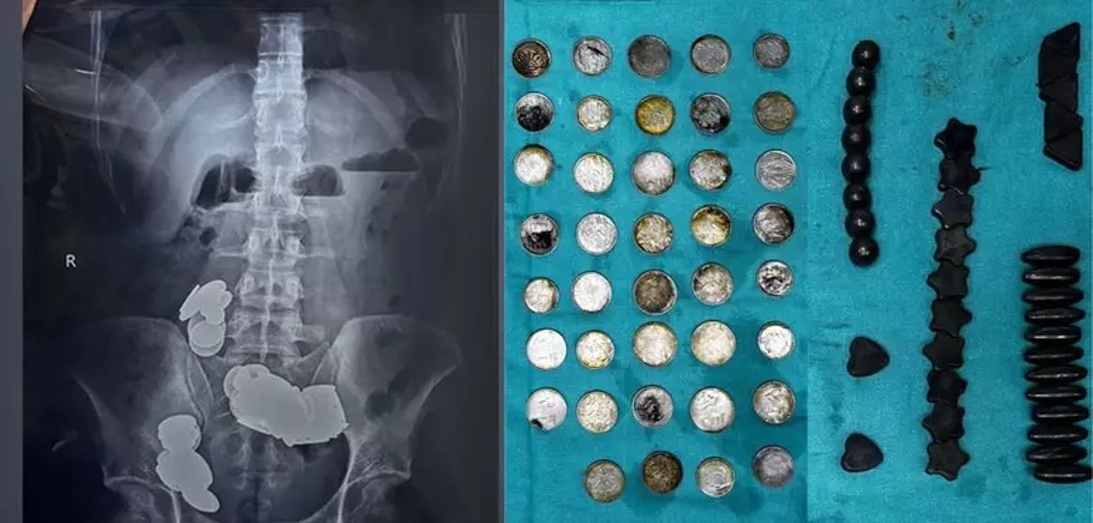 Homem engole mais de 70 moedas e ímãs por achar que ‘zinco ajudava na musculação’  