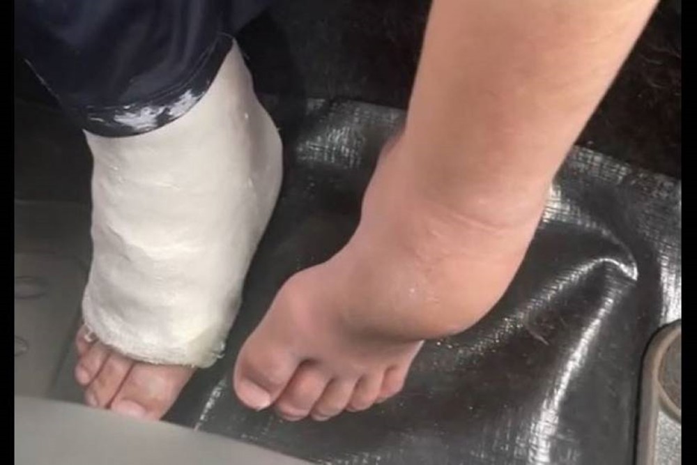 Menino autista de 12 anos tem pé engessado por engano em Vilhena