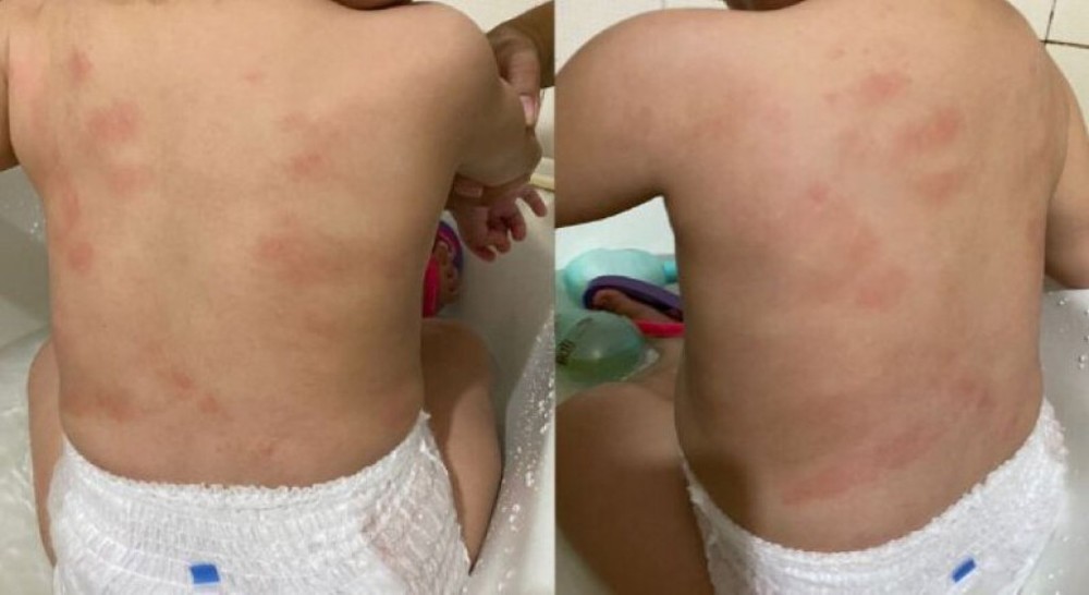 Menina de 1 ano volta de creche com hematomas e mãe denuncia à polícia